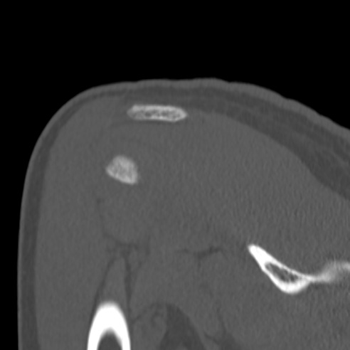 Bankart lesion (Radiopaedia 57256-64185 Coronal bone window 38).jpg