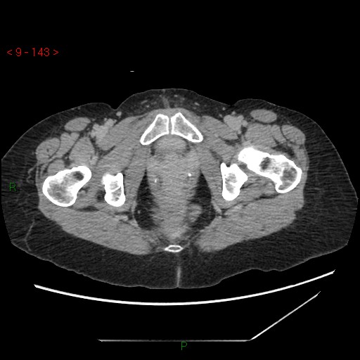 File:Bartholin gland cyst (Radiopaedia 54904-61181 Axial C+ delayed 36).jpg