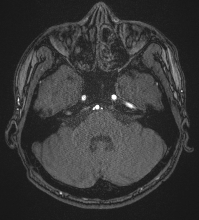 Basal ganglia subacute infarct (Radiopaedia 80201-93521 Axial MRA 17).png