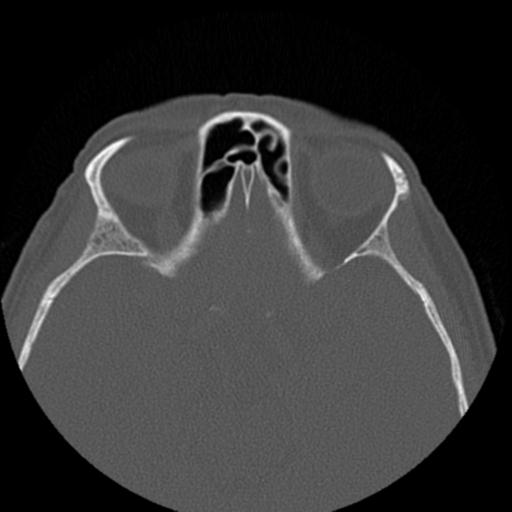 File:Base of skull chondrosarcoma (Radiopaedia 30410-31071 Axial bone window 31).jpg