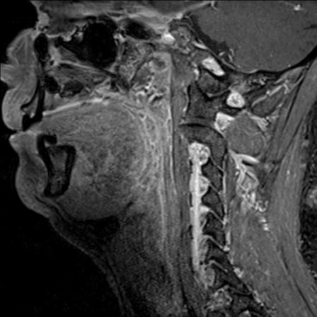 Base of tongue squamous cell carcinoma (Radiopaedia 31174-31884 F 109).jpg