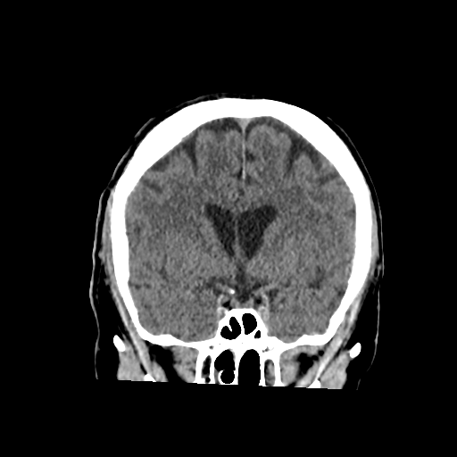 Basilar and bilateral vertebral artery occlusion (Radiopaedia 45592-49723 Coronal 28).png