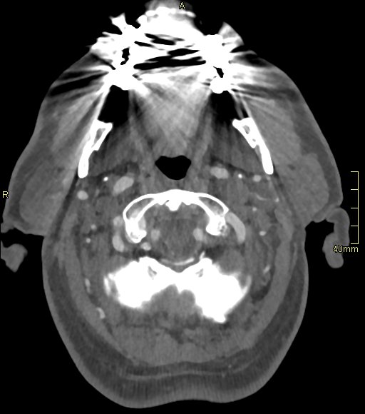 Basilar artery aneurysm (Radiopaedia 56261-62932 A 30).jpg