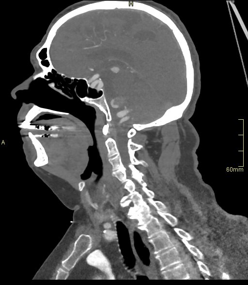 Basilar artery aneurysm (Radiopaedia 56261-62932 C 25).jpg