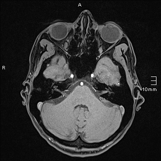 Basilar artery perforator aneurysm (Radiopaedia 82455-99523 F 29).jpg