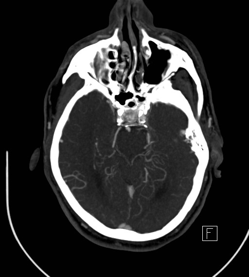 Basilar artery thrombosis (Radiopaedia 26986-27163 A 35).jpg