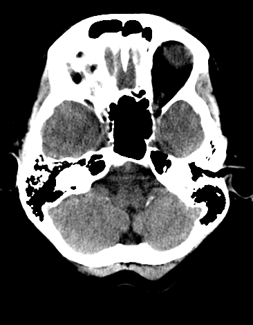 File:Basilar tip aneurysm with coiling (Radiopaedia 53912-60033 Axial 19).jpg