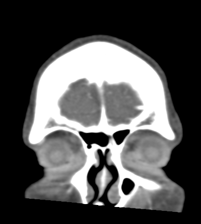Basilar tip aneurysm with coiling (Radiopaedia 53912-60086 B 6).jpg