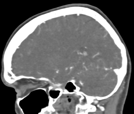 File:Basilar tip aneurysm with coiling (Radiopaedia 53912-60086 C 44).jpg