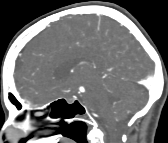 Basilar tip aneurysm with coiling (Radiopaedia 53912-60086 C 61).jpg