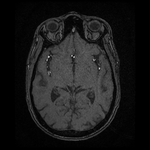 Basilar top and left middle cerebral artery aneurysm (Radiopaedia 61965-70031 Axial MRA 76).jpg