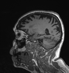 Behavioral variant frontotemporal dementia and late onset schizophrenia (Radiopaedia 52197-58083 Sagittal T1 26).png