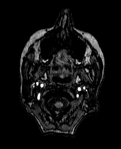 Berry aneurysm of the terminal internal carotid artery (Radiopaedia 88286-104918 Axial TOF 13).jpg