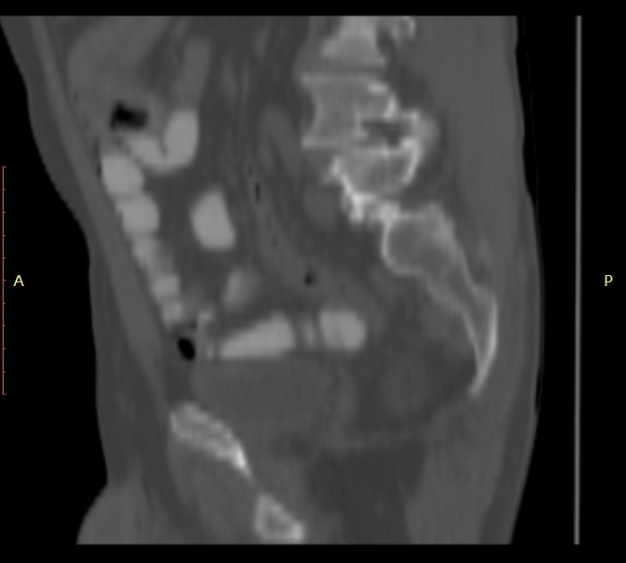 Bertolotti syndrome (Radiopaedia 58974-66235 Sagittal bone window 39).jpg
