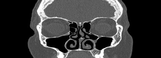 Bilateral Ectopic Infraorbital Nerves (Radiopaedia 49006-54084 Coronal bone window 25).jpg