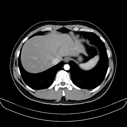 Bilateral accessory renal arteries with mild pelvi-ureteric junction (PUJ) obstruction (Radiopaedia 66357-75596 A 2).jpg