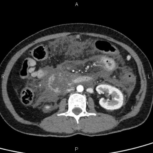 Bilateral adrenal gland hyperenhancement in pancreatitis (Radiopaedia 86642-102753 B 68).jpg