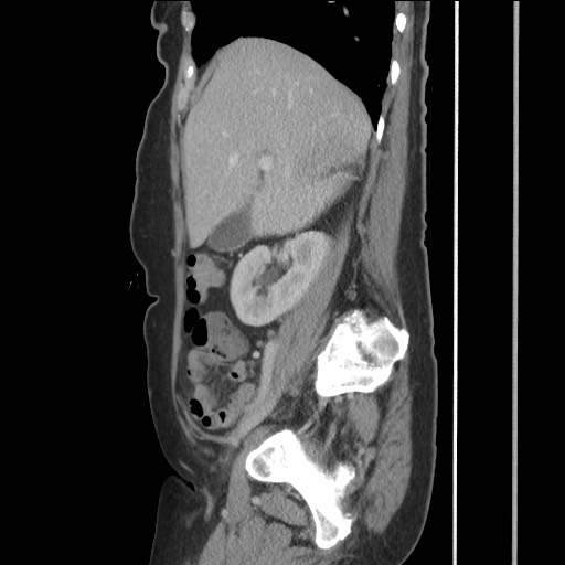 Bilateral adrenal granulocytic sarcomas (chloromas) (Radiopaedia 78375-91007 C 52).jpg