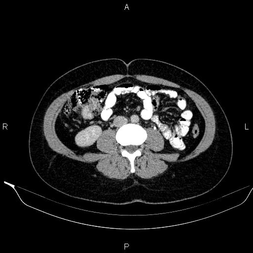 Bilateral adrenal myelolipoma (Radiopaedia 63058-71535 Axial C+ delayed 81).jpg