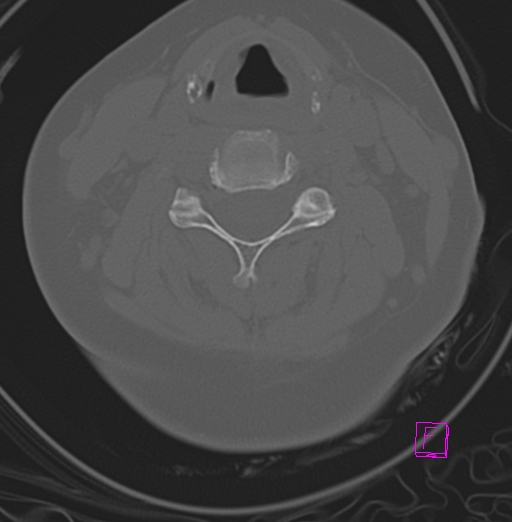 File:Bilateral atlanto-occipital assimilation (Radiopaedia 28350-28603 Axial bone window 23).jpg