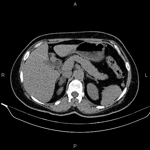 File:Bilateral benign adrenal adenomas (Radiopaedia 86912-103124 Axial non-contrast 36).jpg