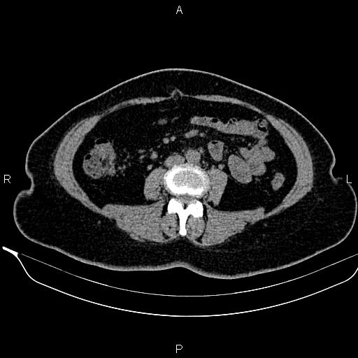 Bilateral benign adrenal adenomas (Radiopaedia 86912-103124 Axial non-contrast 65).jpg