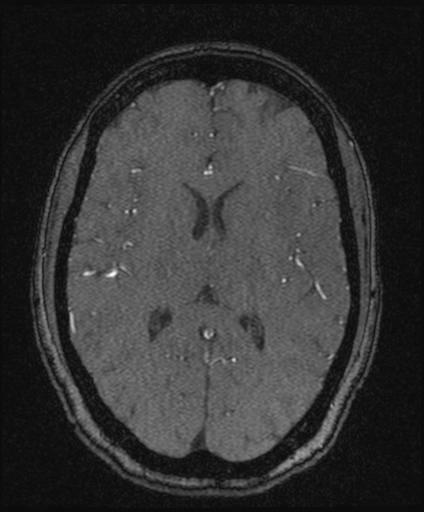 Bilateral carotid body tumors and right glomus jugulare tumor (Radiopaedia 20024-20060 Axial MRA 105).jpg