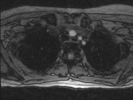 Bilateral carotid body tumors and right glomus jugulare tumor (Radiopaedia 20024-20060 Axial MRA 166).jpg
