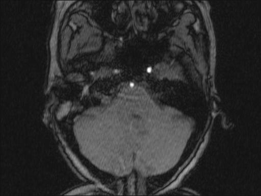 Bilateral carotid body tumors and right glomus jugulare tumor (Radiopaedia 20024-20060 Axial MRA 318).jpg