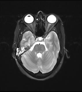 File:Bilateral carotid body tumors and right jugular paraganglioma (Radiopaedia 20024-20060 Axial 20).jpg