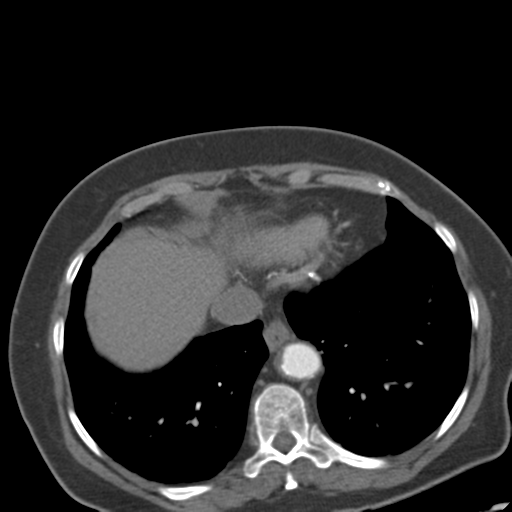 File:Bilateral delayed nephrogram from renal artery stenosis (Radiopaedia 47681-52362 A 5).png