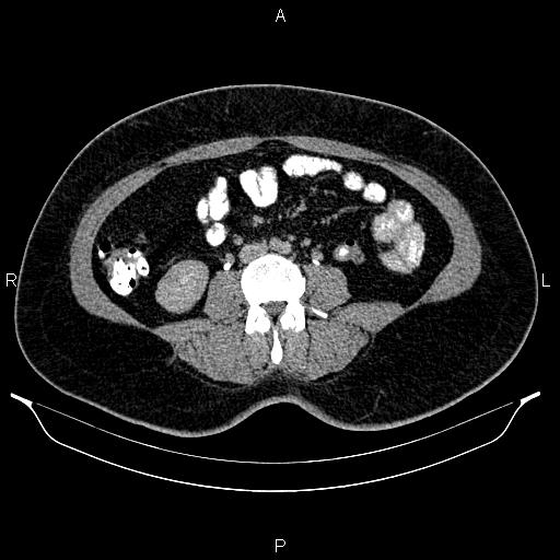 Bilateral ovarian dermoid cysts (Radiopaedia 85785-101603 Axial C+ delayed 41).jpg