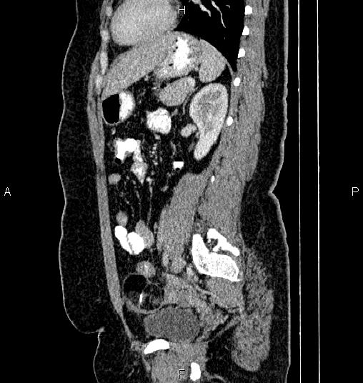 Bilateral ovarian dermoid cysts (Radiopaedia 85785-101603 D 61).jpg