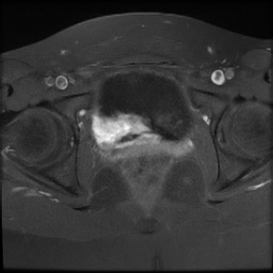 File:Bilateral ovarian fibrothecomas - adolescent (Radiopaedia 86604-102707 Axial T1 C+ fat sat 24).jpg