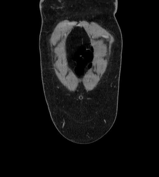 File:Bilateral ovarian mature cystic teratomas (Radiopaedia 79373-92457 B 2).jpg