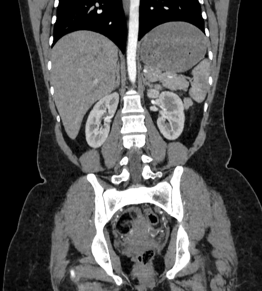 Bilateral ovarian mature cystic teratomas (Radiopaedia 79373-92457 B 56).jpg