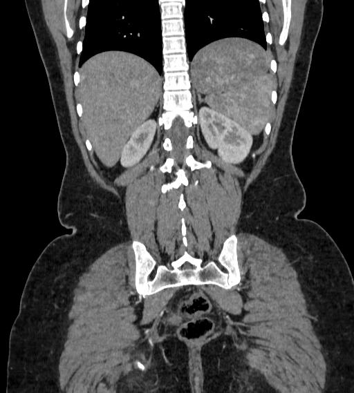File:Bilateral ovarian mature cystic teratomas (Radiopaedia 79373-92457 B 80).jpg