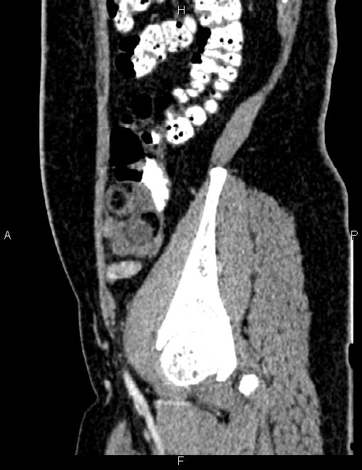 Bilateral ovarian teratoma (Radiopaedia 83131-97503 D 37).jpg