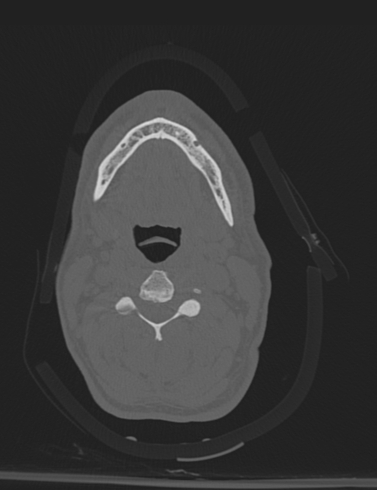 Bilateral perched facet joint (Radiopaedia 63149-71669 Axial bone window 22).jpg