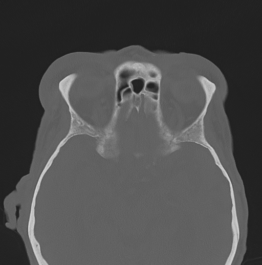 File:Bilateral preseptal periorbital cellulitis (Radiopaedia 43081-46350 Axial bone window 13).png