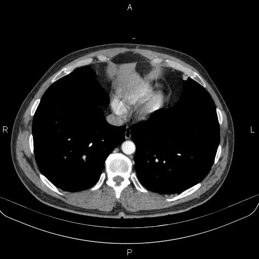 Bilateral pulmonary AVM (Radiopaedia 83134-97505 A 55).jpg