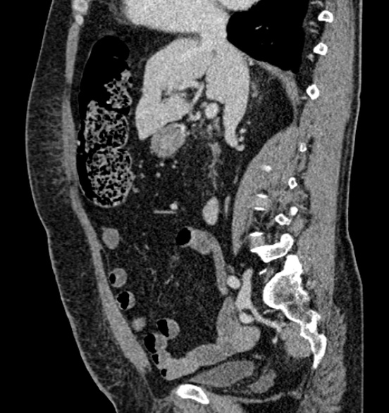 Bilateral rectus sheath hematomas (Radiopaedia 50778-56252 B 35).jpg