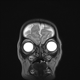 File:Bilateral subdural hemorrhage and parietal skull fracture (Radiopaedia 26058-26190 Coronal T2 1).png