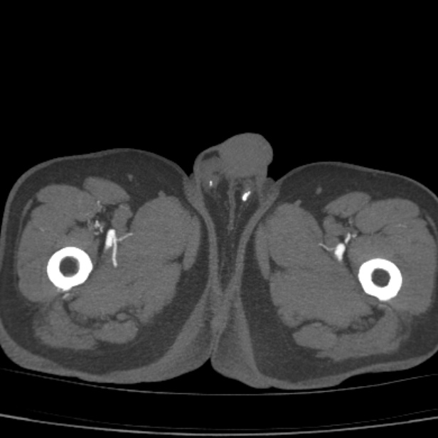 Bilateral superficial femoral arterial occlusion (Radiopaedia 25682-25857 A 33).jpg