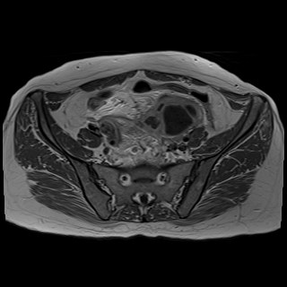 Bilateral tubo-ovarian abscesses (Radiopaedia 58635-65829 Axial T1 C+ 14).jpg
