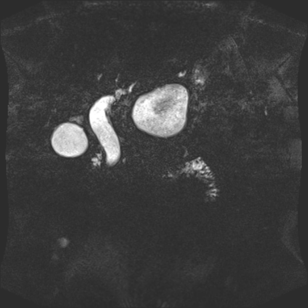 Biliary pancreatitis (Radiopaedia 72289-82824 Coronal 3D T2 37).jpg