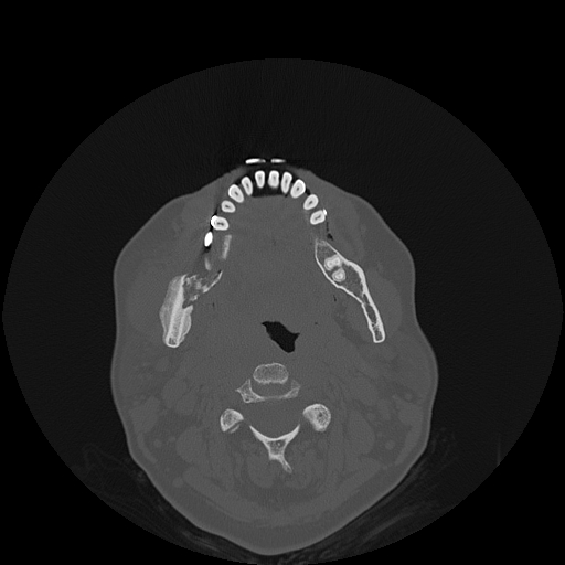 File:Bisphosphonate-related osteonecrosis of the jaw (Radiopaedia 71324-81642 Axial bone window 66).jpg