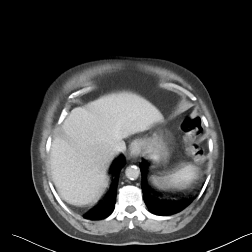 File:Bladder papillary urothelial carcinoma (Radiopaedia 48119-52951 Axial 2).png