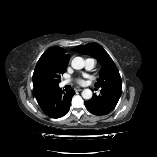 File:Bladder tumor detected on trauma CT (Radiopaedia 51809-57609 B 1).jpg
