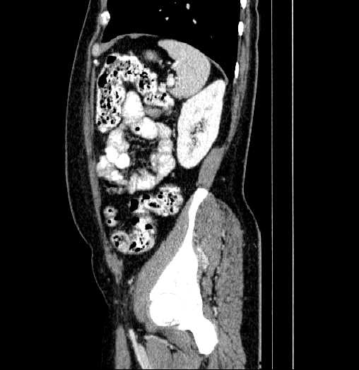 Blind-ending branch of a bifid ureter (Radiopaedia 61159-69048 B 66).jpg